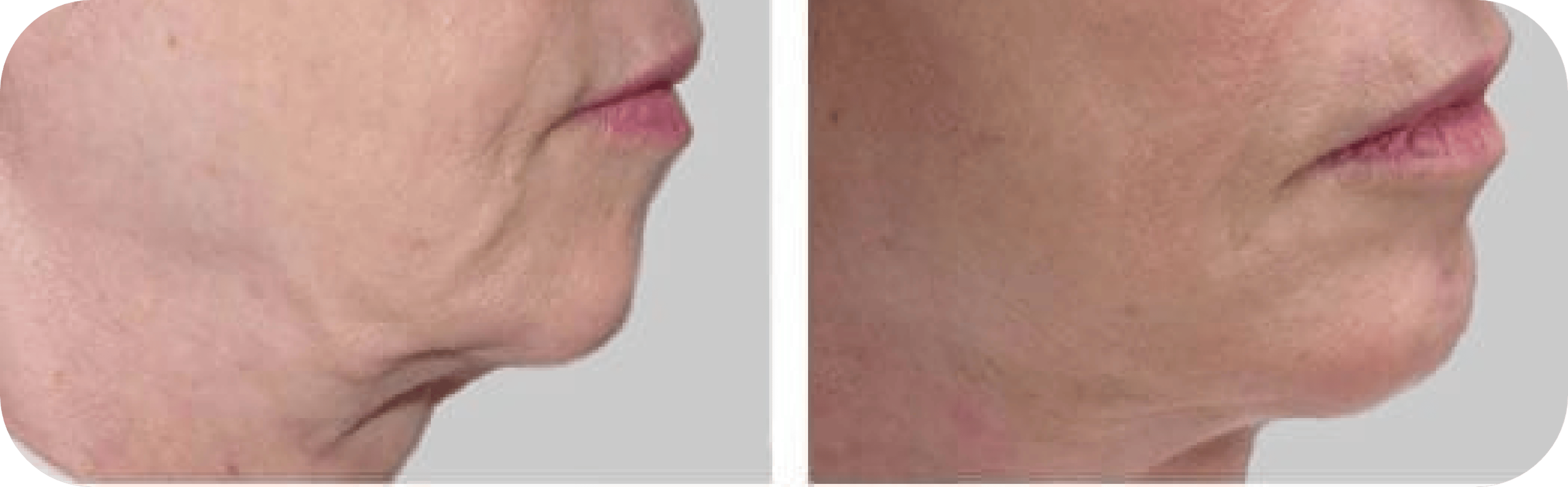 Results of neck skin tightening treatment