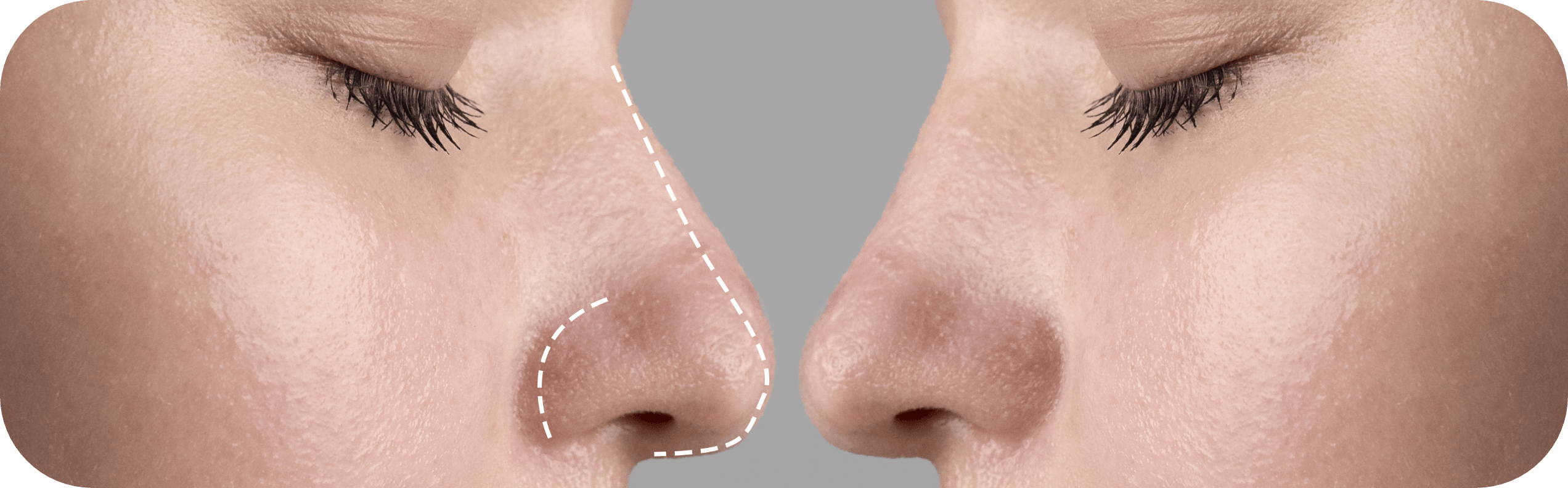 The Non-Surgical Nosejob