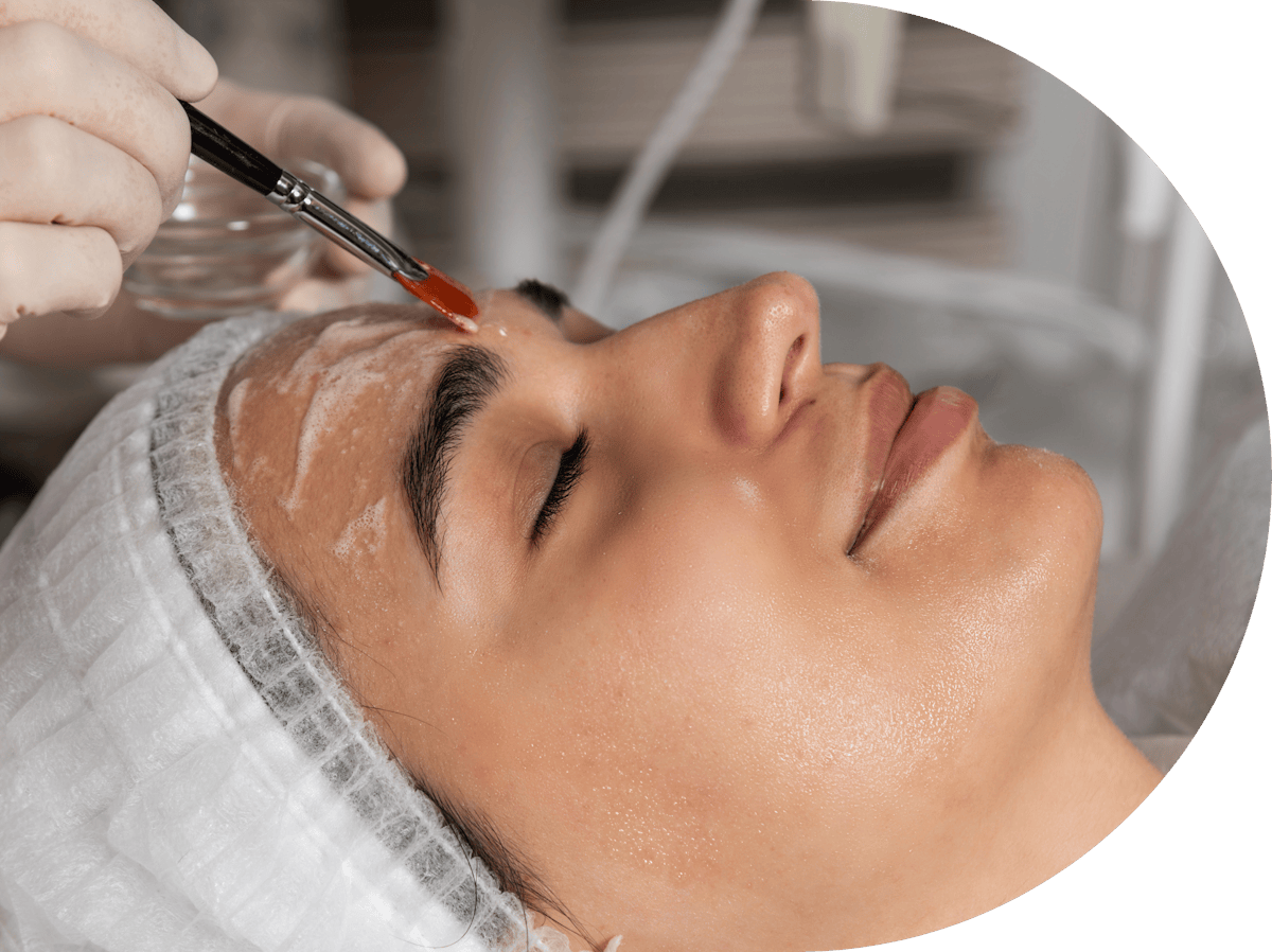 Mesopeel treatment being performed