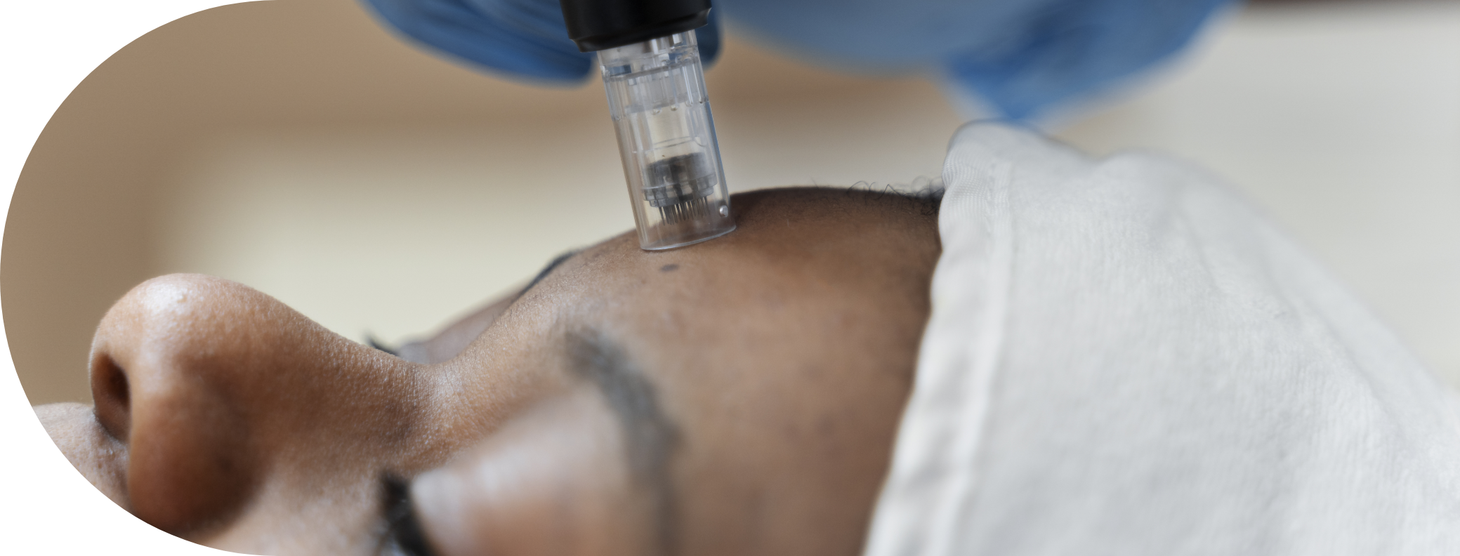 A black woman having full face micro needling treatment