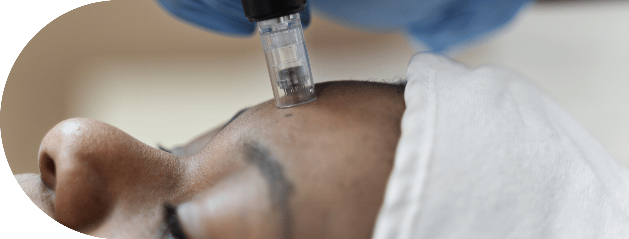 A black woman having full face micro needling treatment