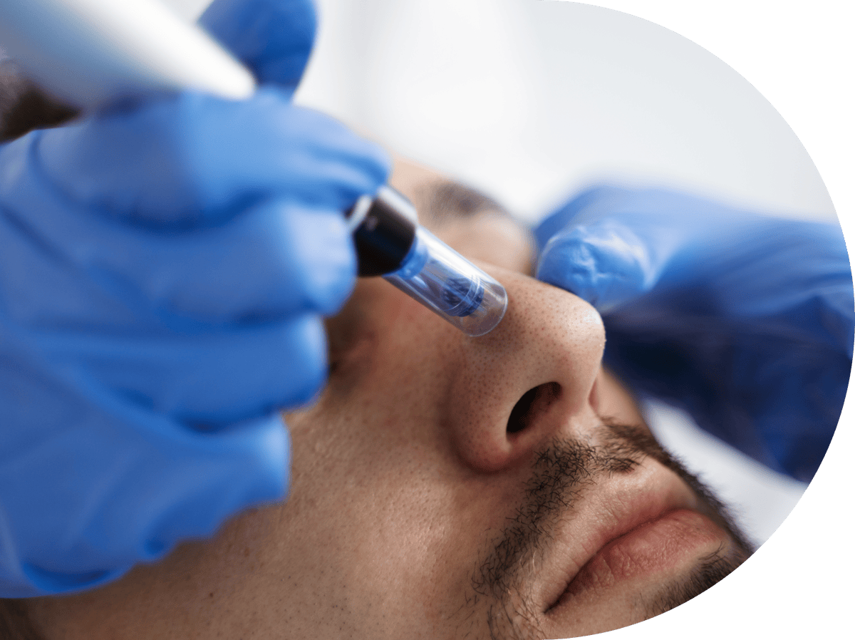 A man having micro needling treatment on his nose
