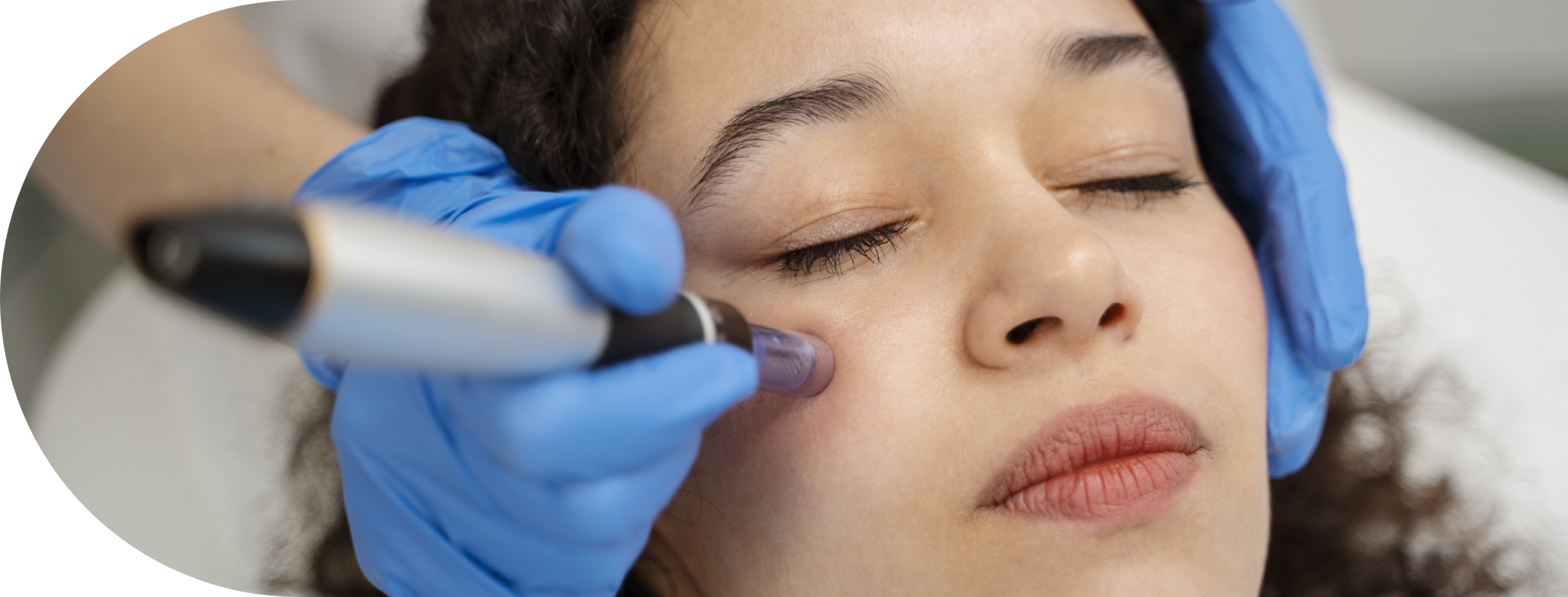 girl having micro needling cheeks treatment