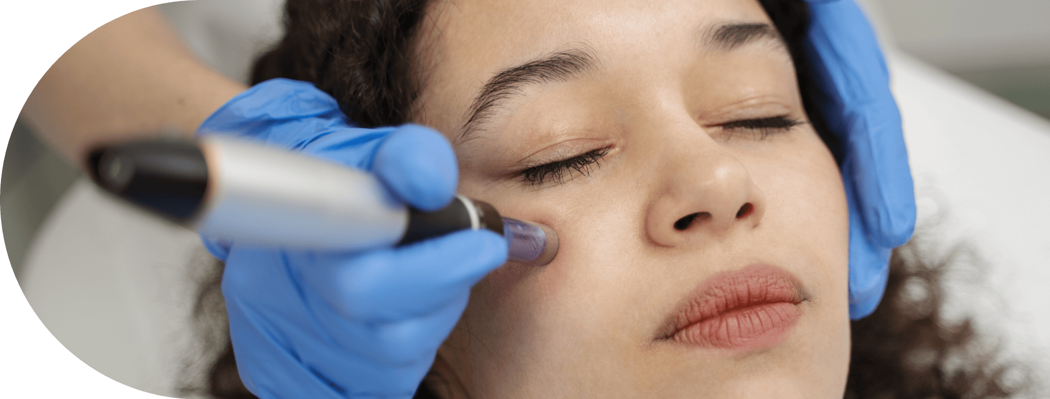 girl having micro needling cheeks treatment