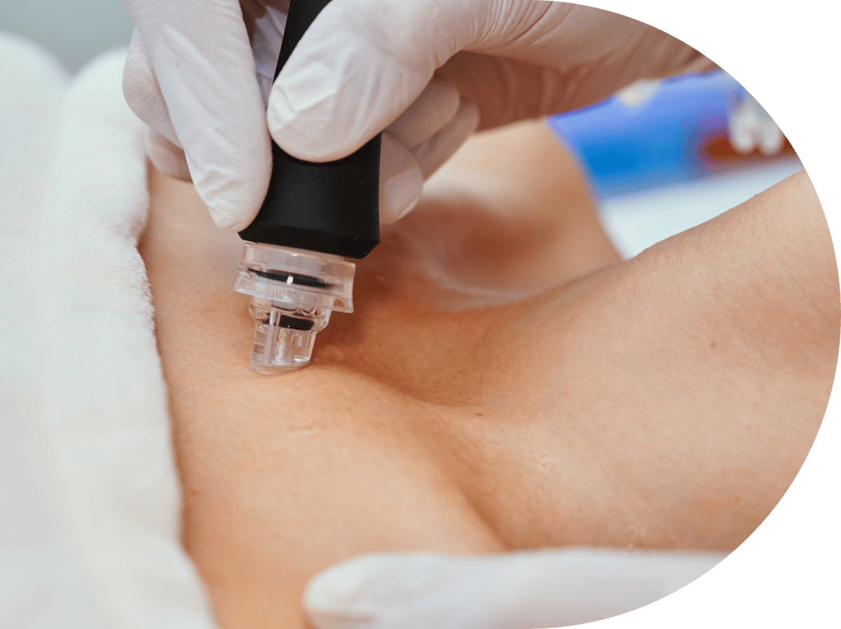 woman having micro needling to her neck area