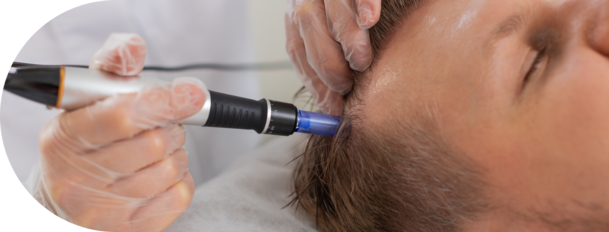 Man having micro needling treatment for hair loss