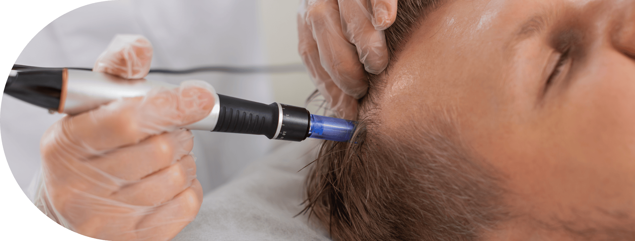 Man having micro needling treatment for hair loss