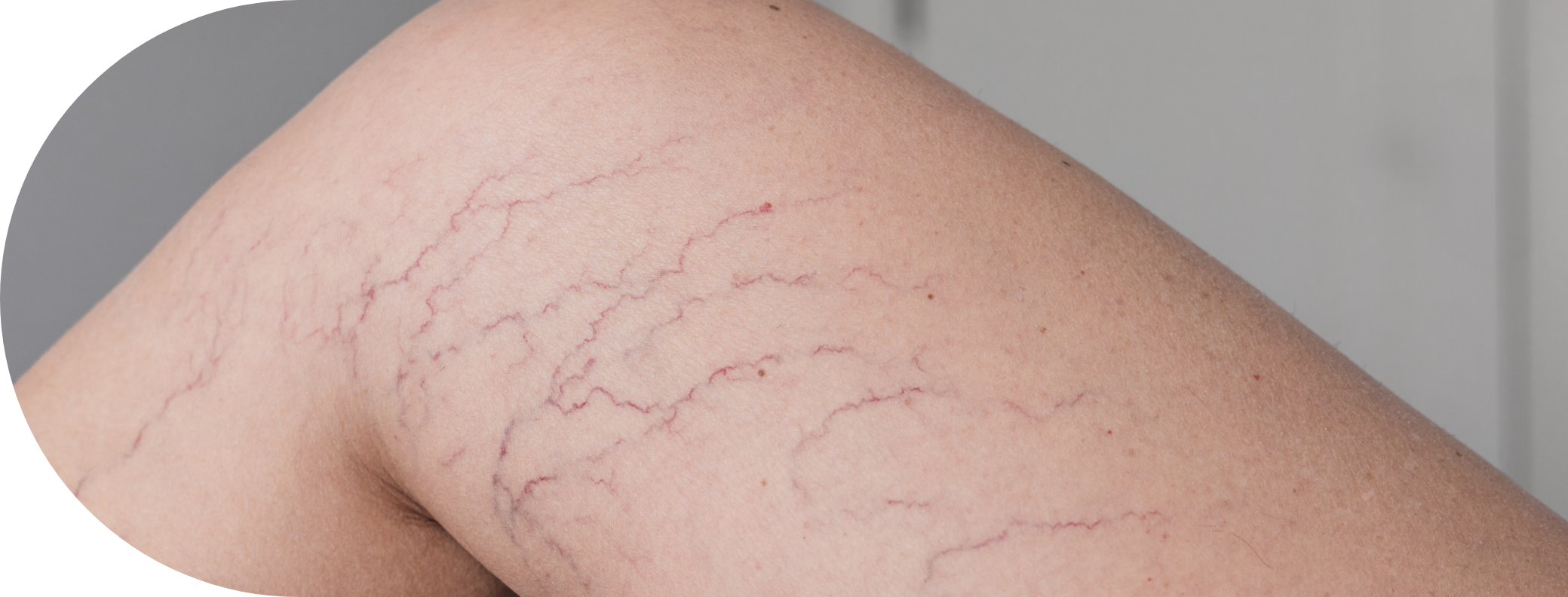 Legs with thread veins