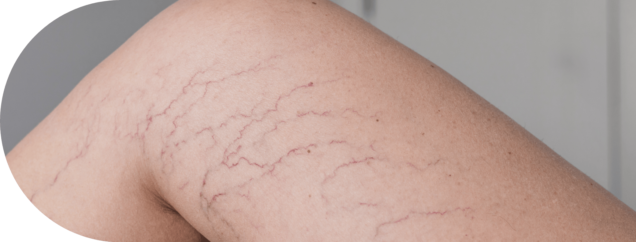 Legs with thread veins