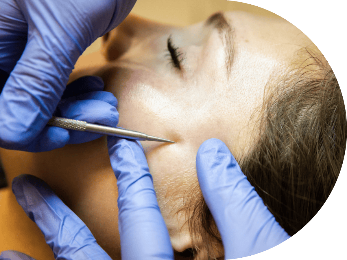 Milla Removal treatment on a woman