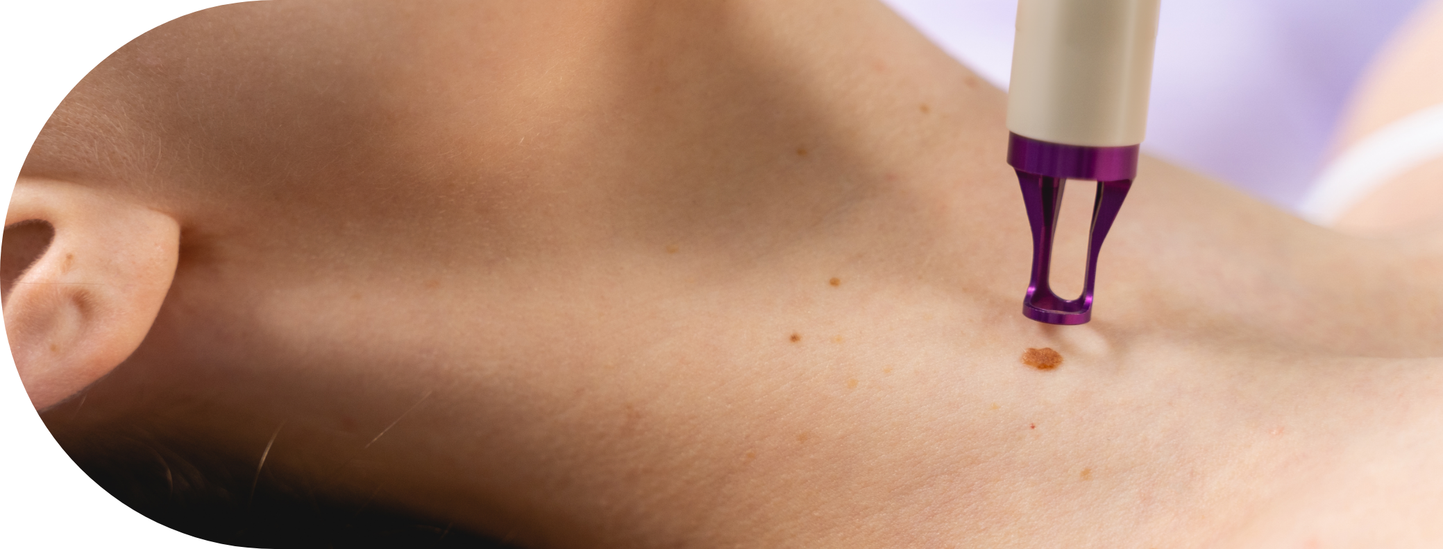 woman having a skin tag removed
