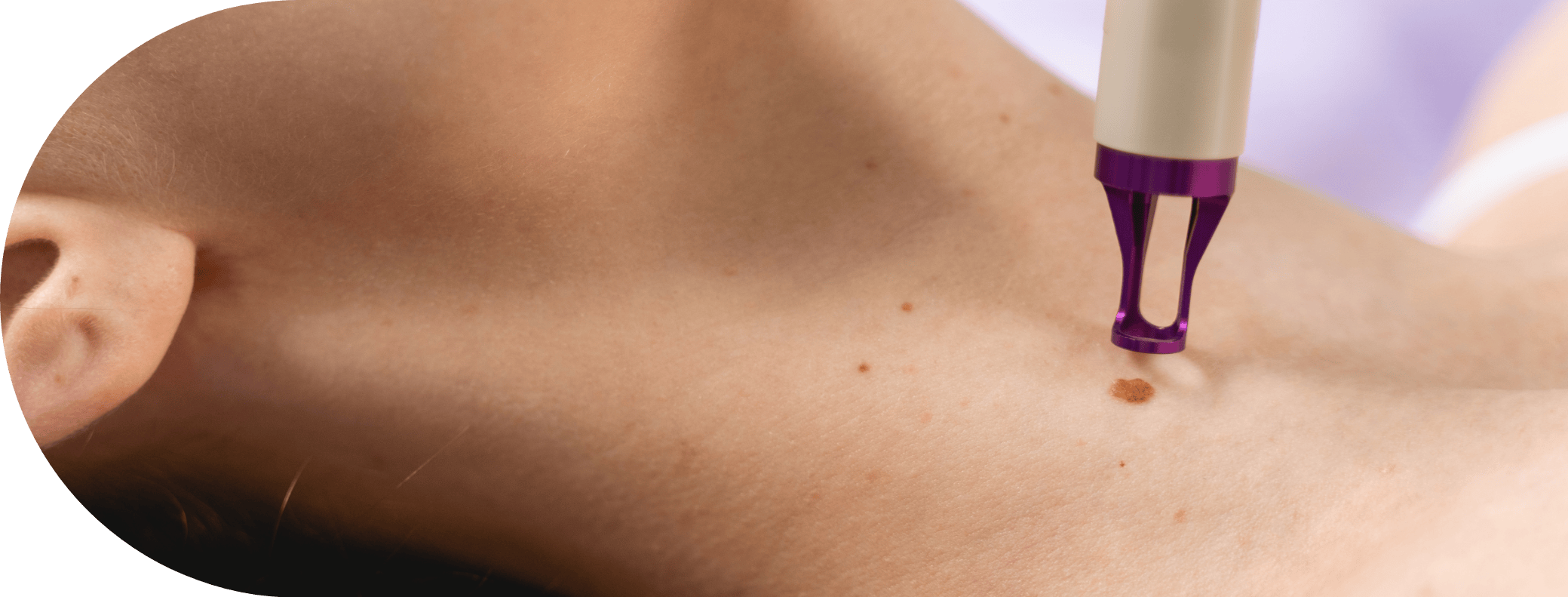 woman having a skin tag removed