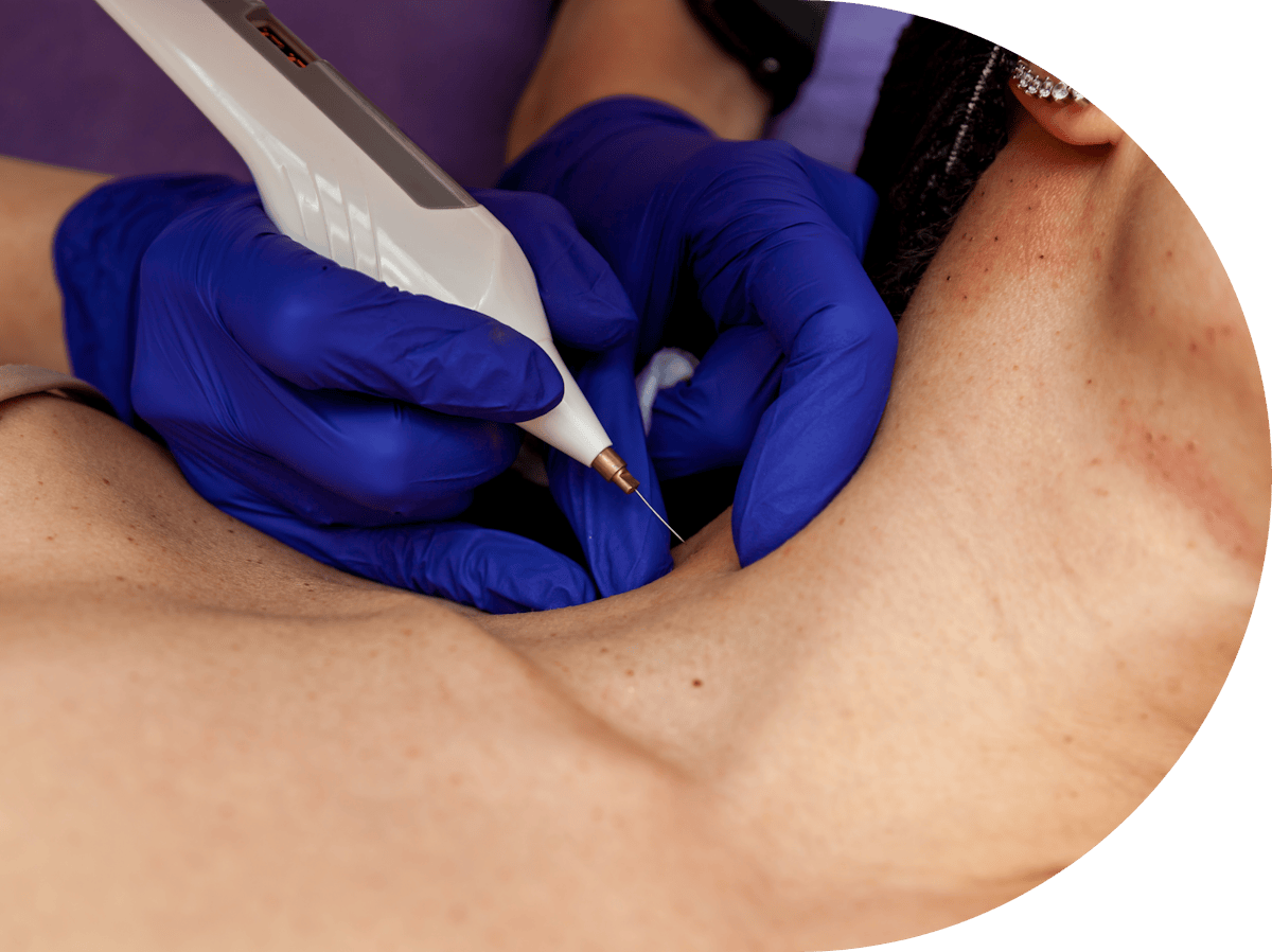 Skin tag removal treatment being performed