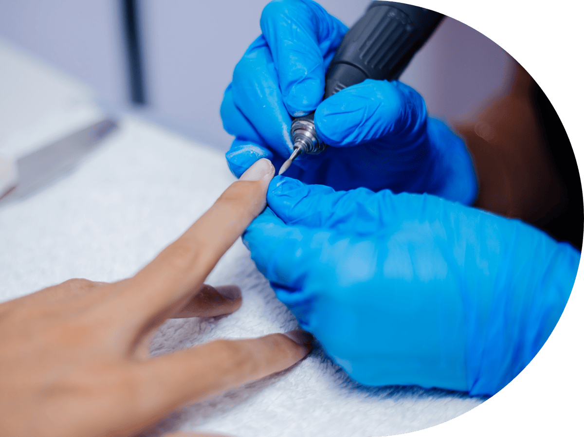 woman having a wart removed from her hand