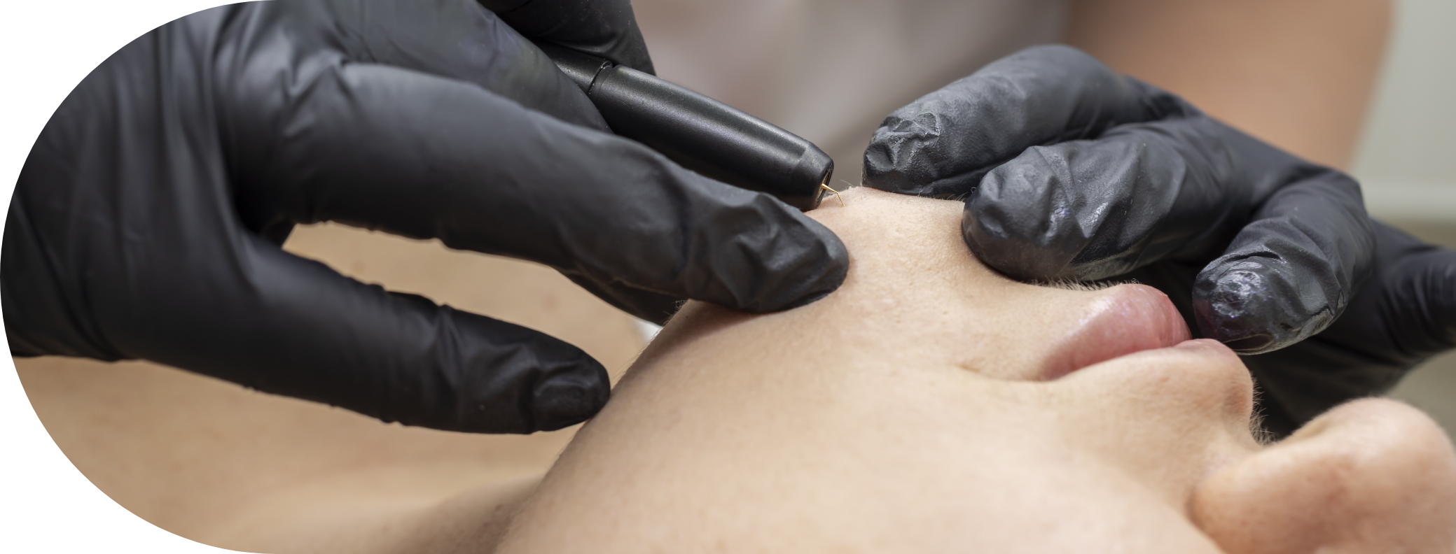 wart removal treatment being performed