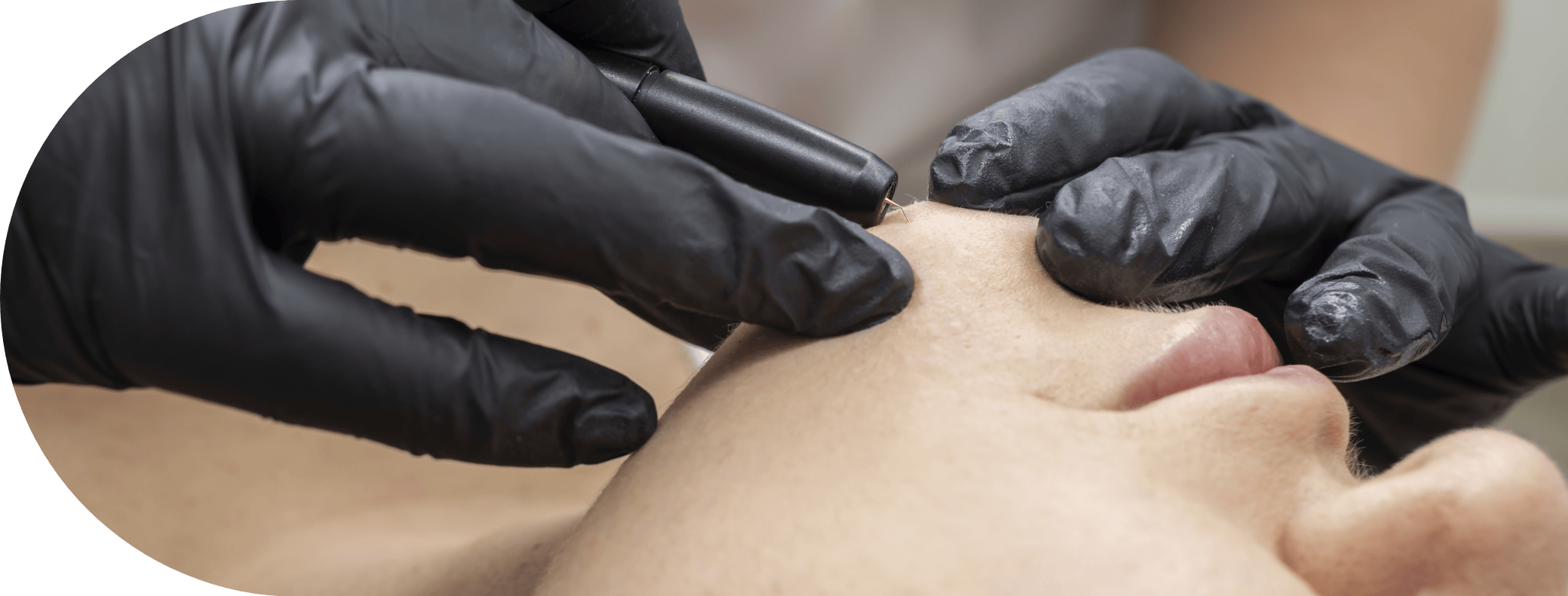 wart removal treatment being performed