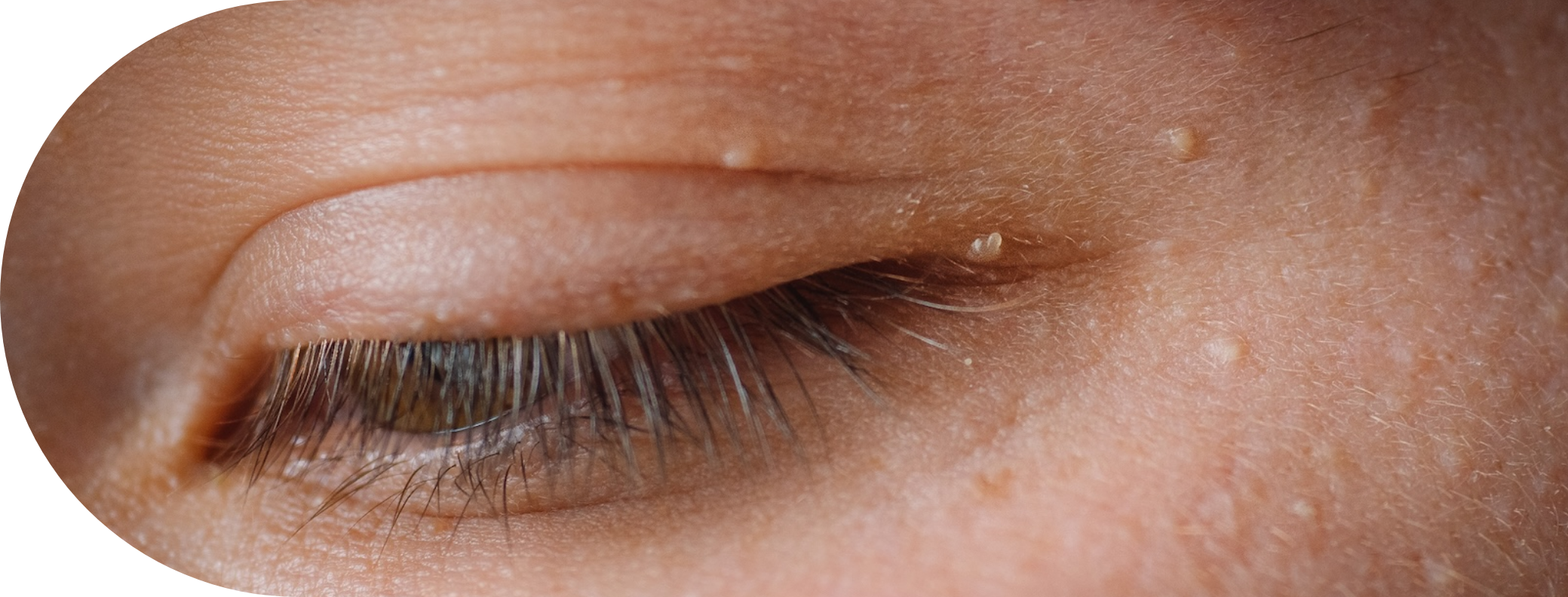 an eye with skin tags