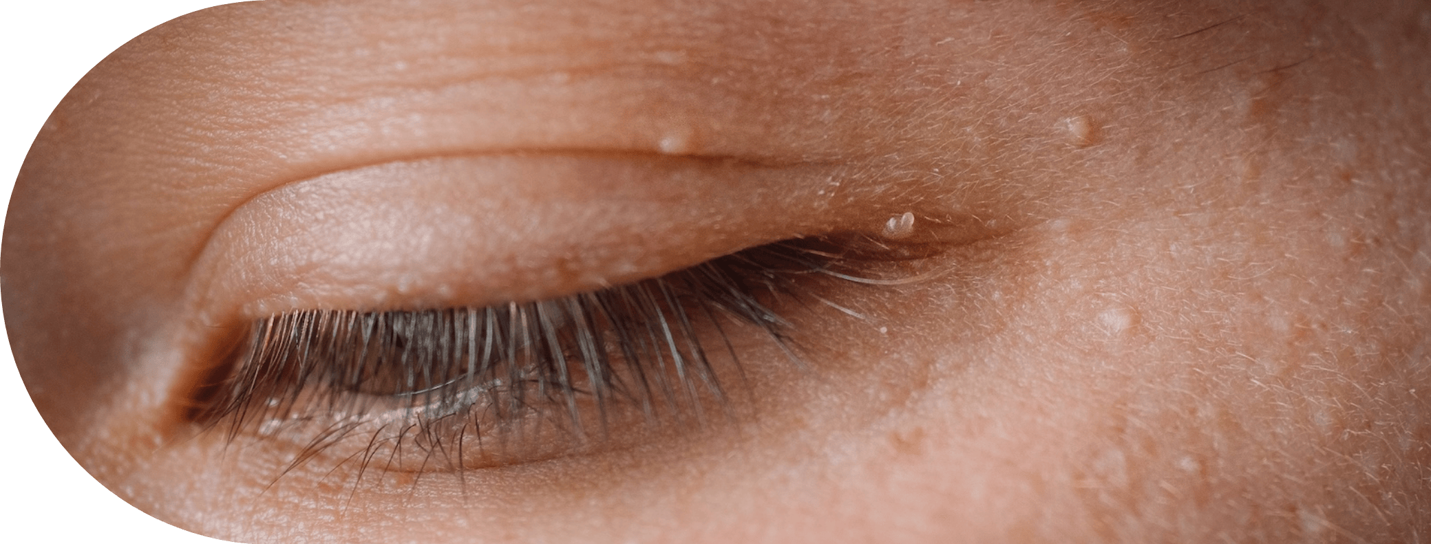 an eye with skin tags