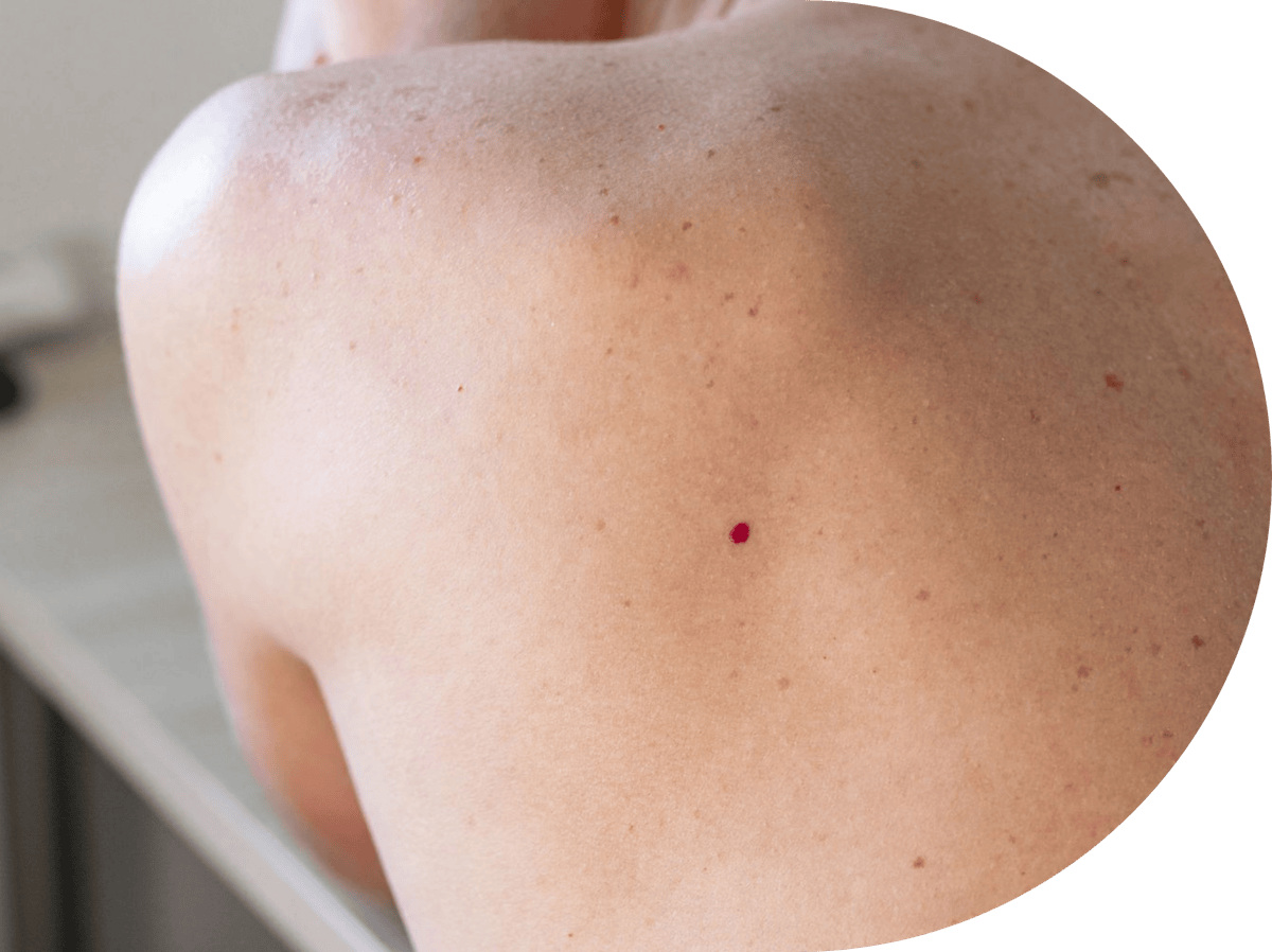 Patient with a cherry angioma on their back