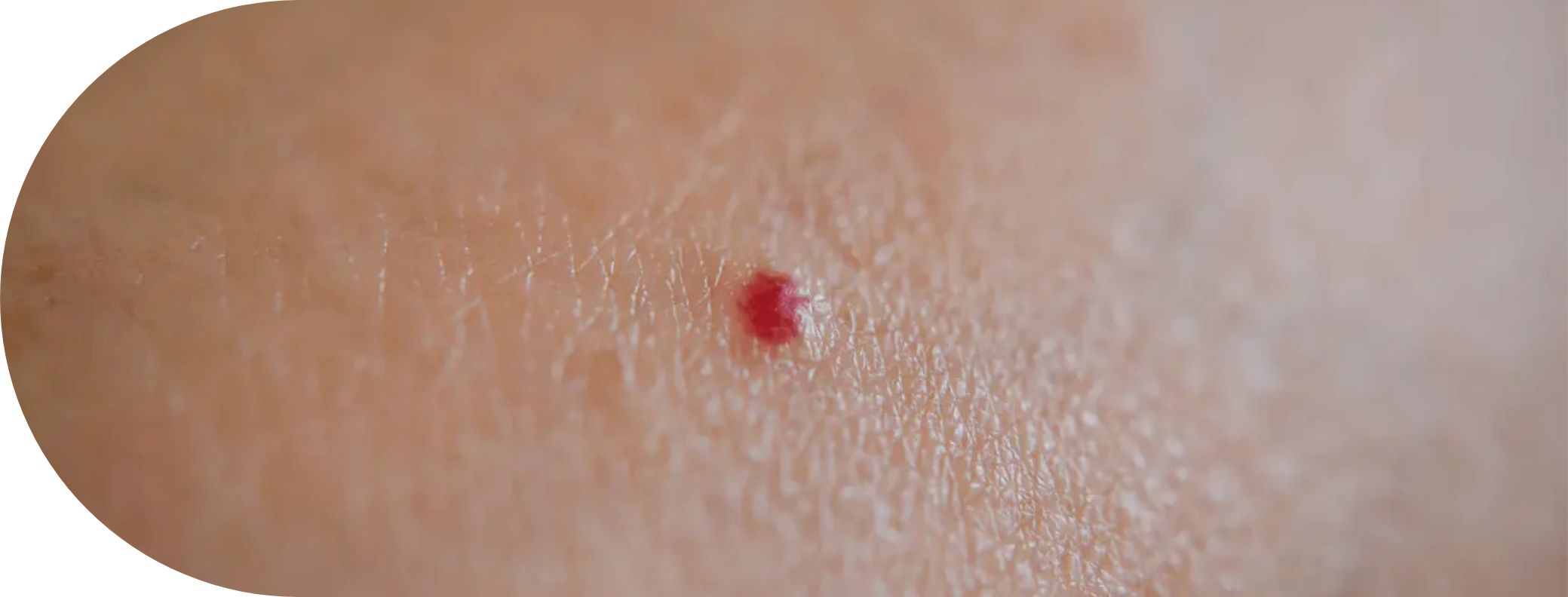 A cherry angioma on skin