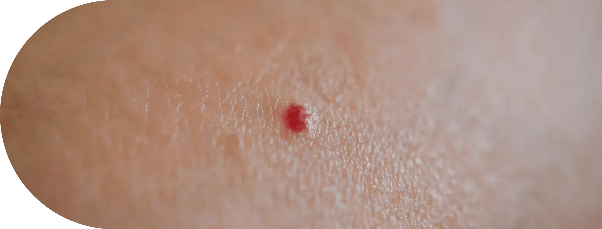 A cherry angioma on skin