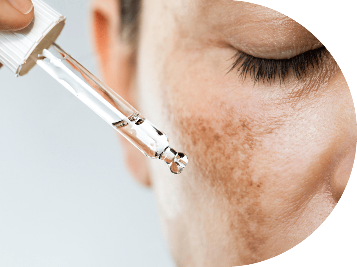 woman getting age spot treatment