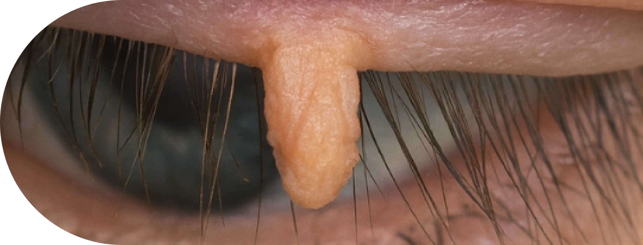 Philiform Wart on an eyelid