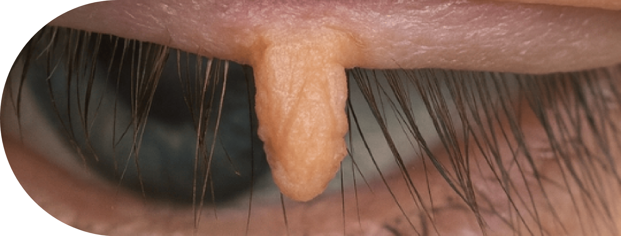 Philiform Wart on an eyelid