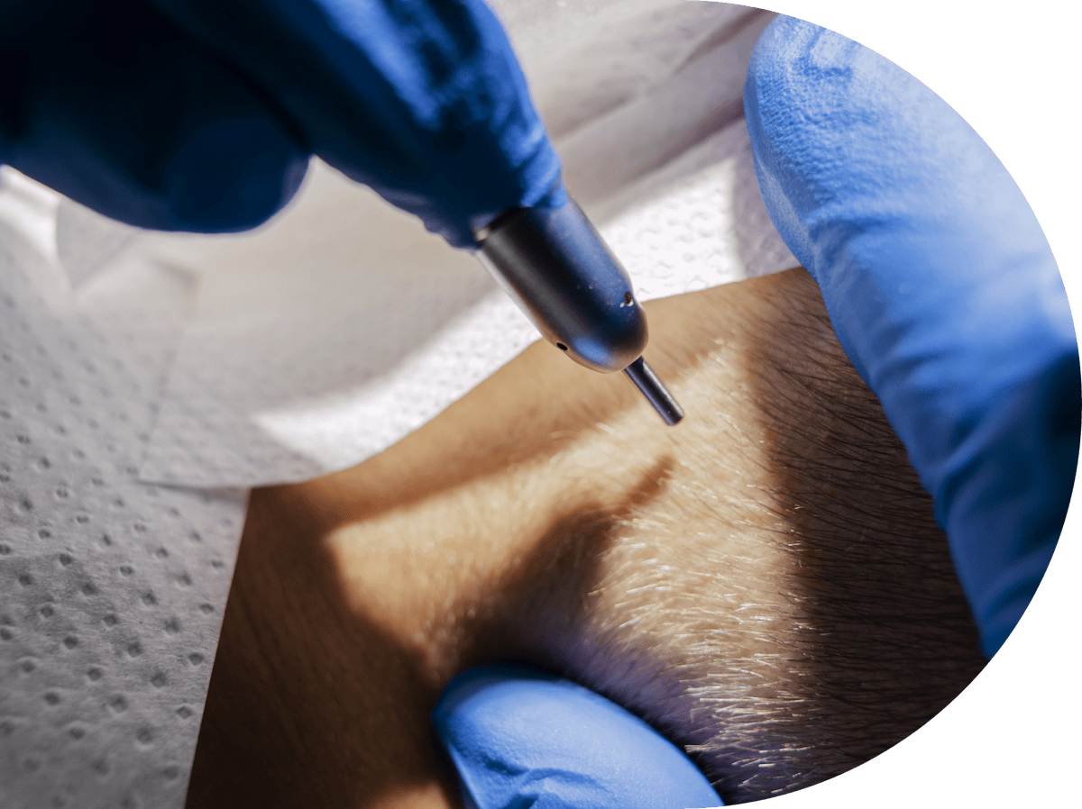 Philiform Wart being removed