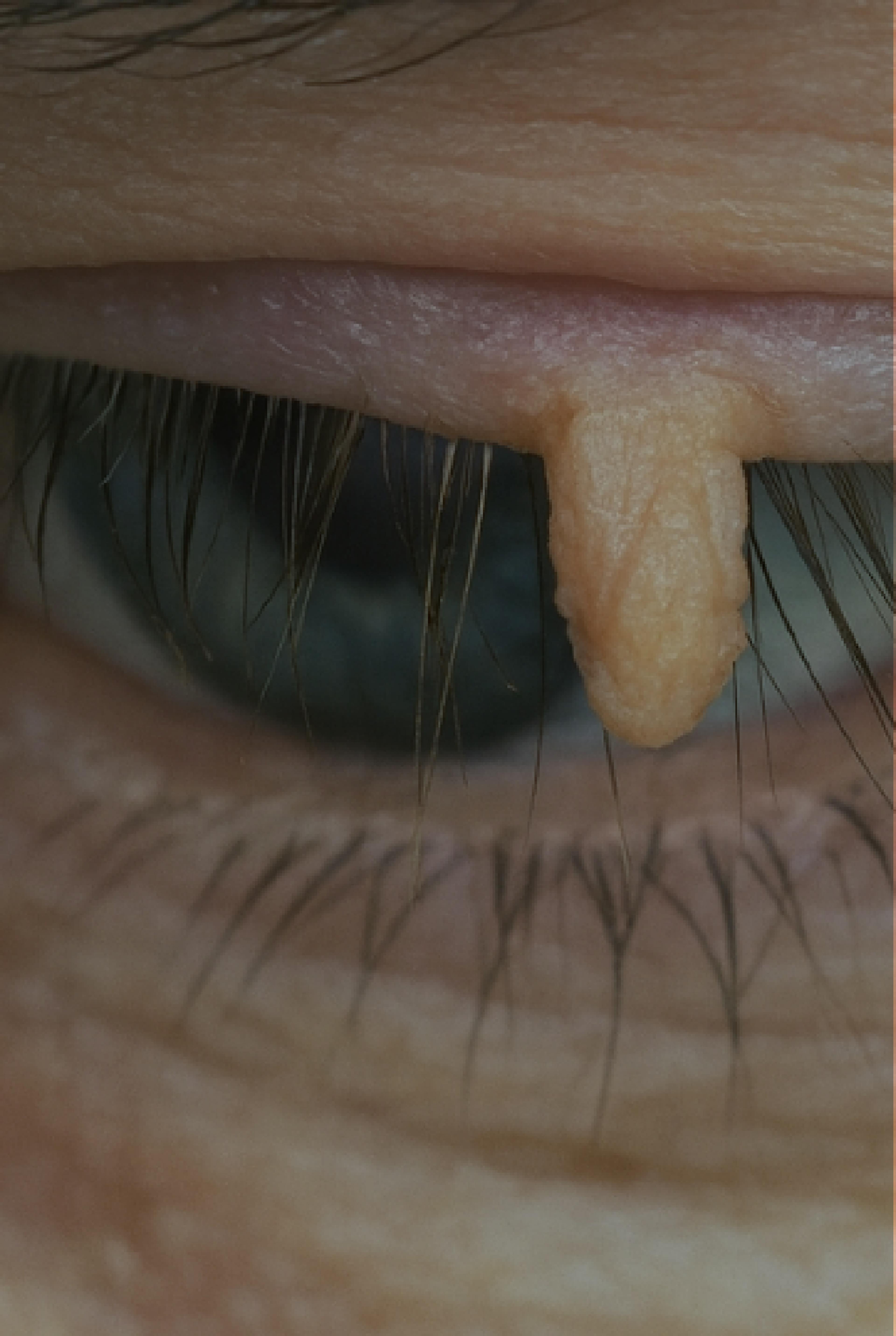 Philiform Wart on the eyelid
