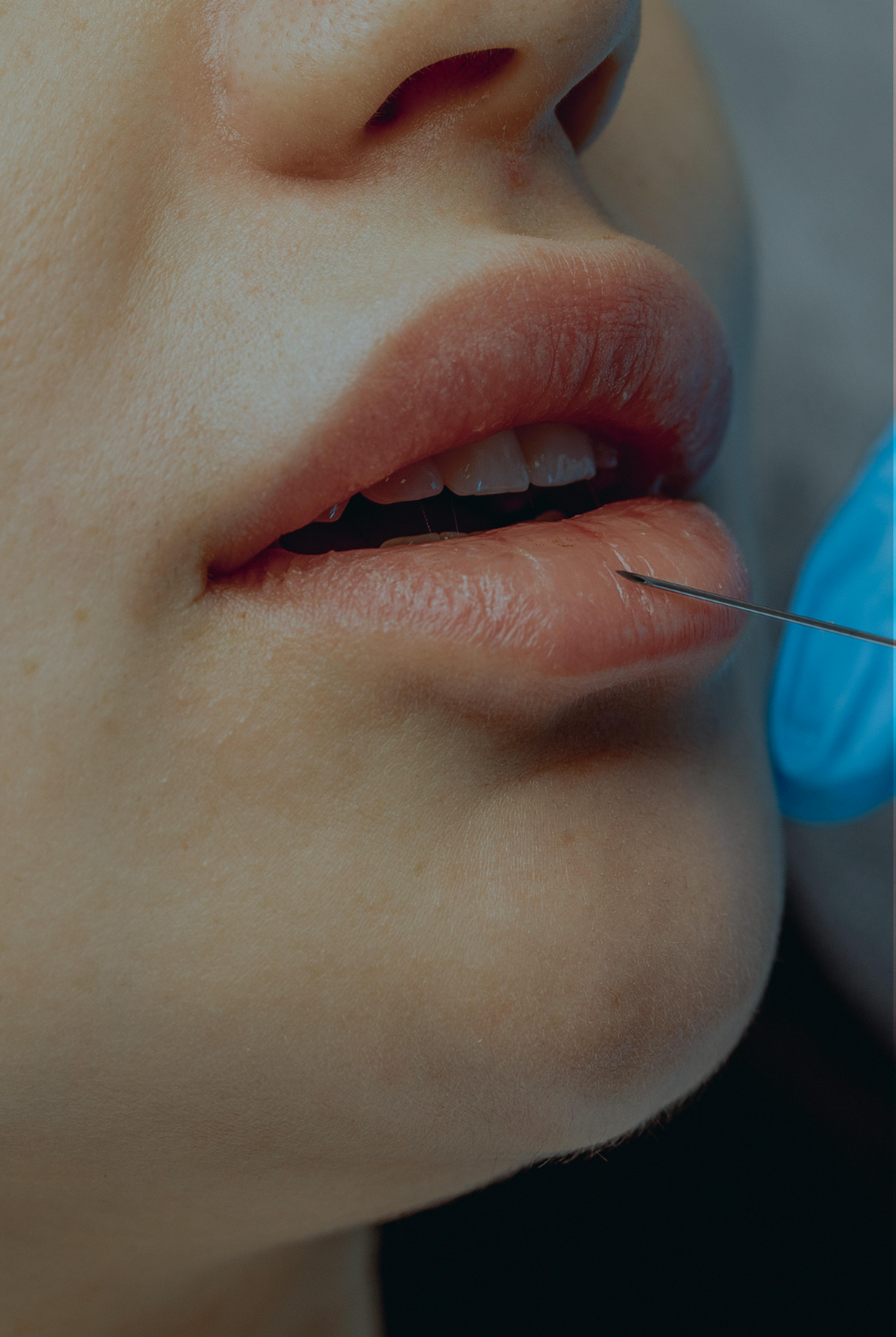 close up of lips having filler treatment