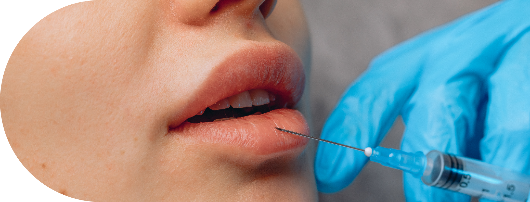 close up of lips having filler treatment