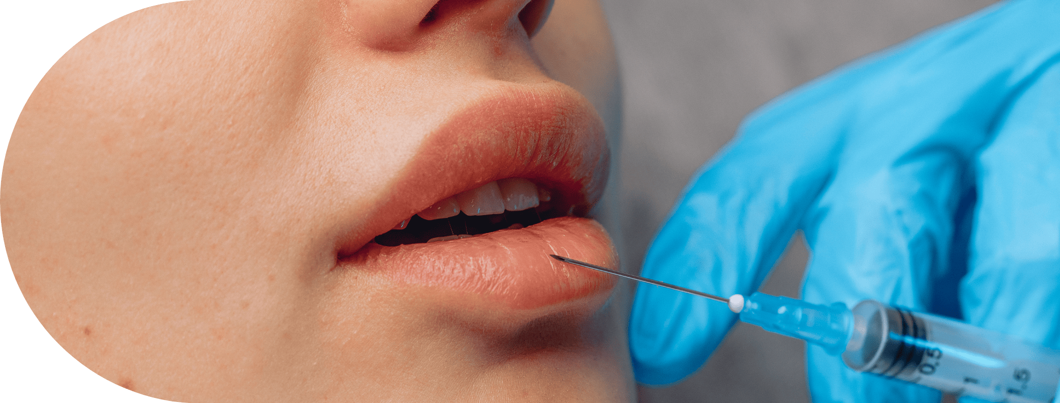 close up of lips having filler treatment