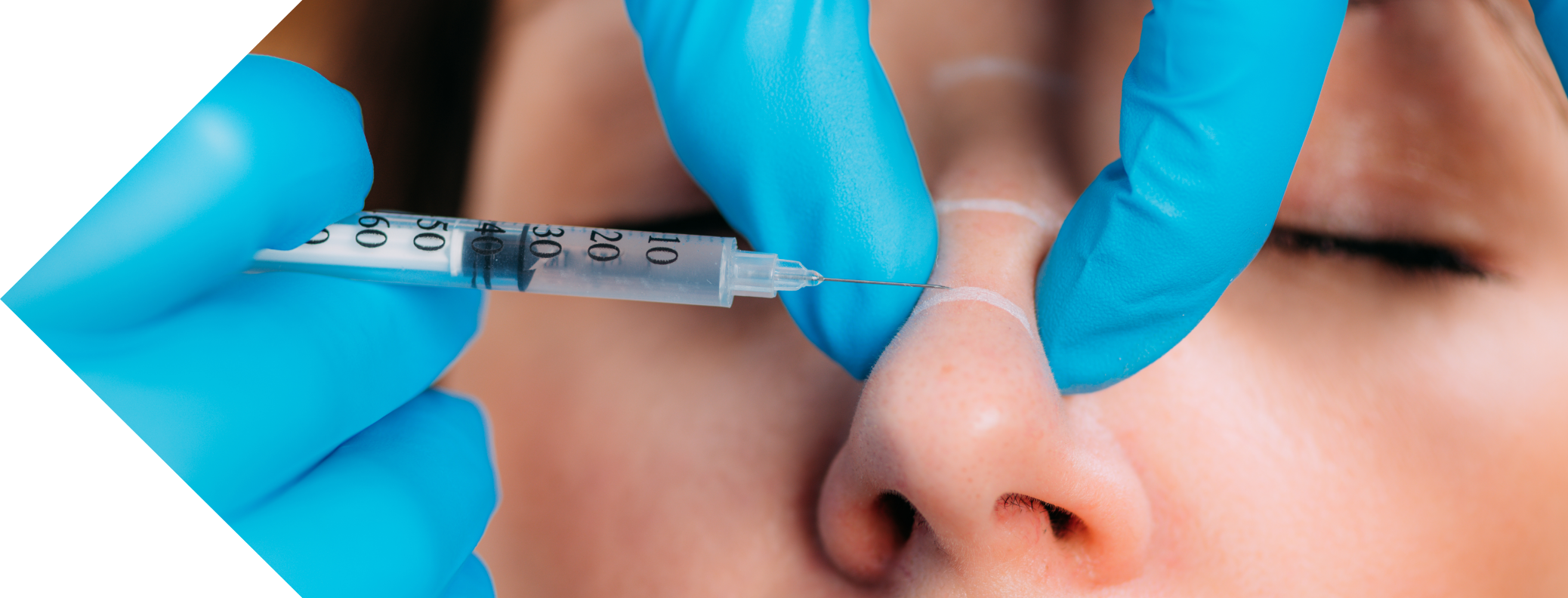 patient having bunny lines treatment
