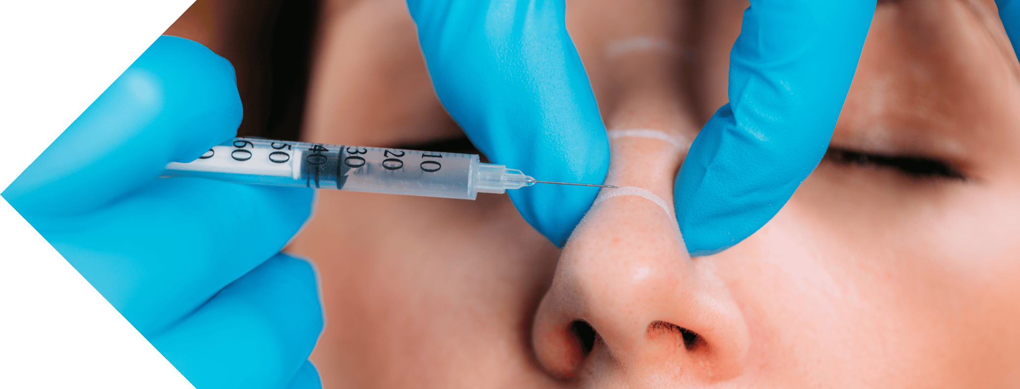 patient having bunny lines treatment