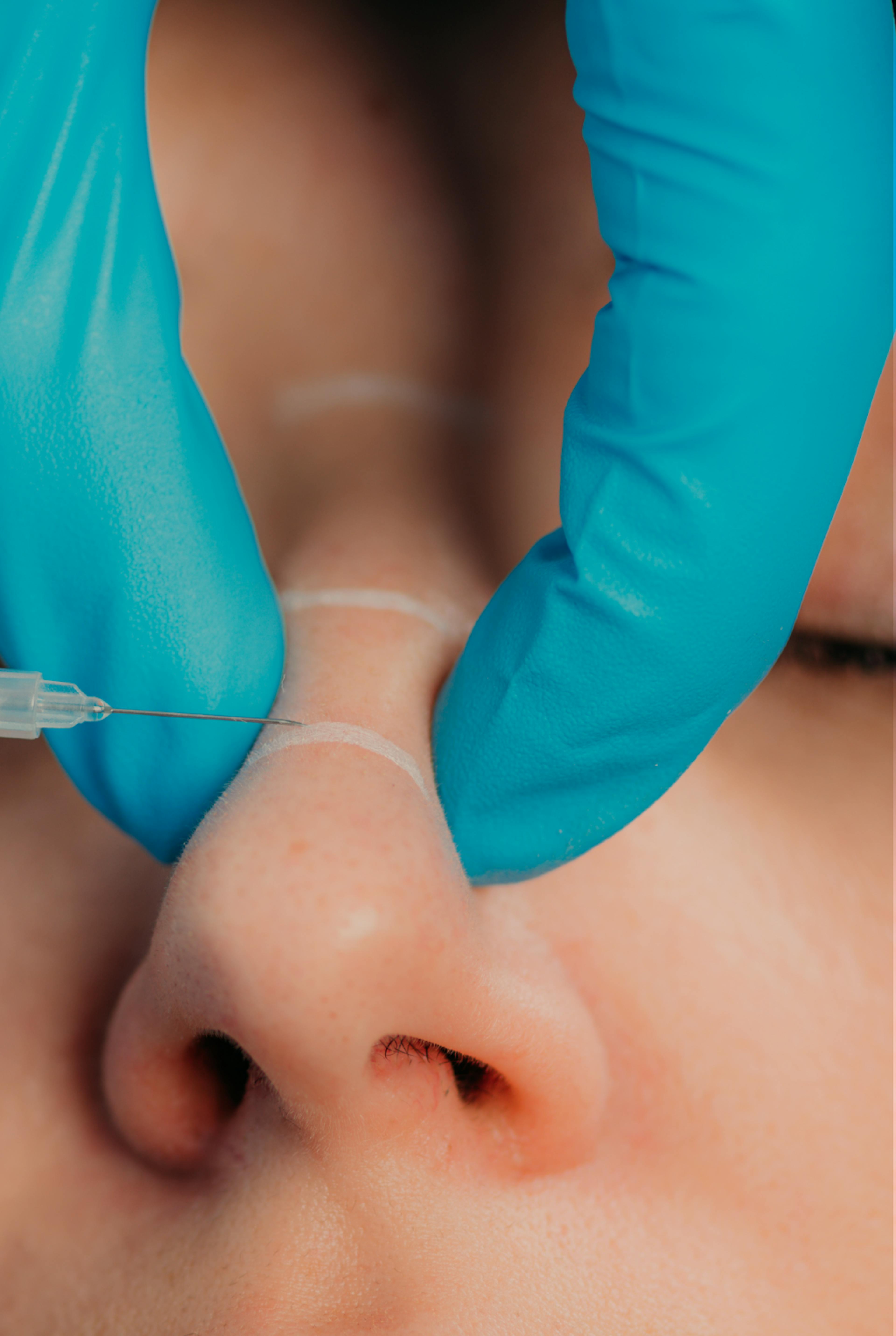 patient having bunny lines treatment