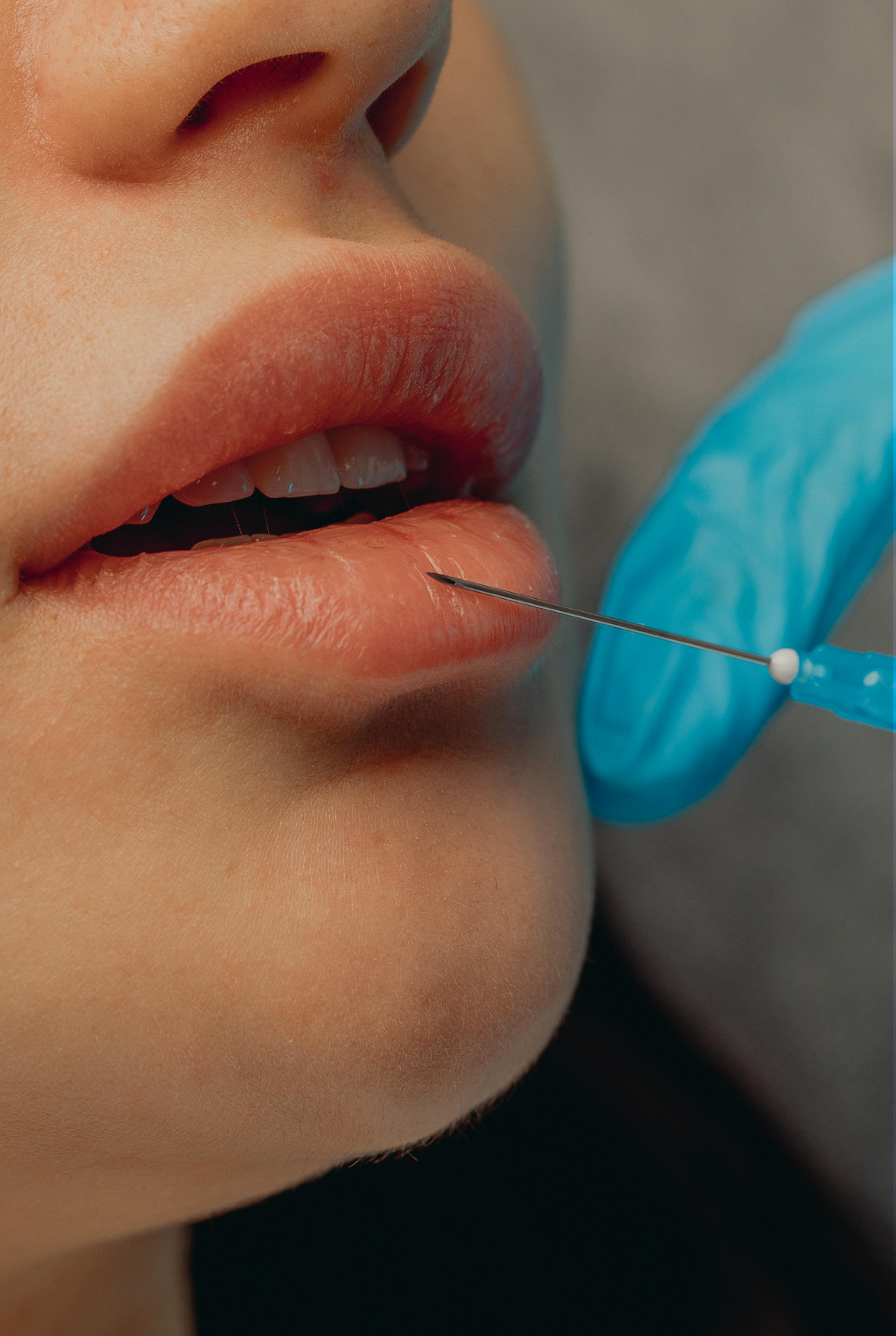 lip filler treatment being performed