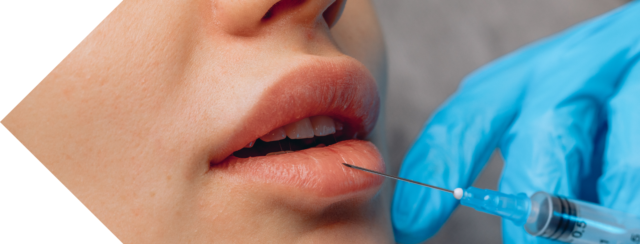 lip filler treatment being performed