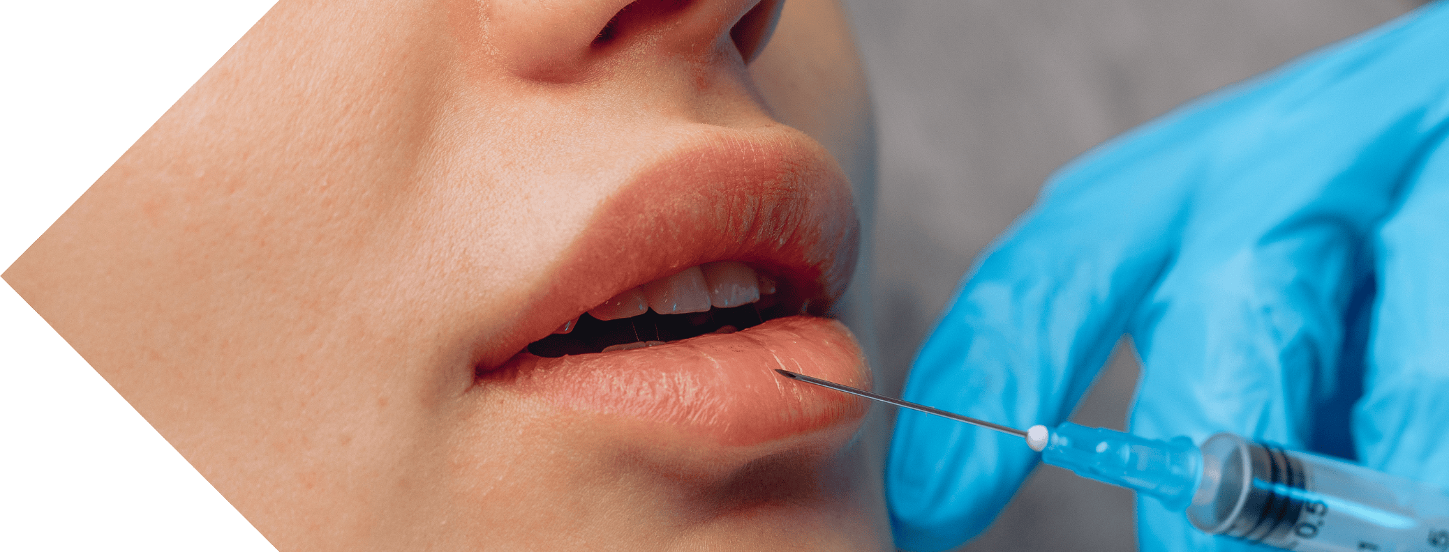 lip filler treatment being performed