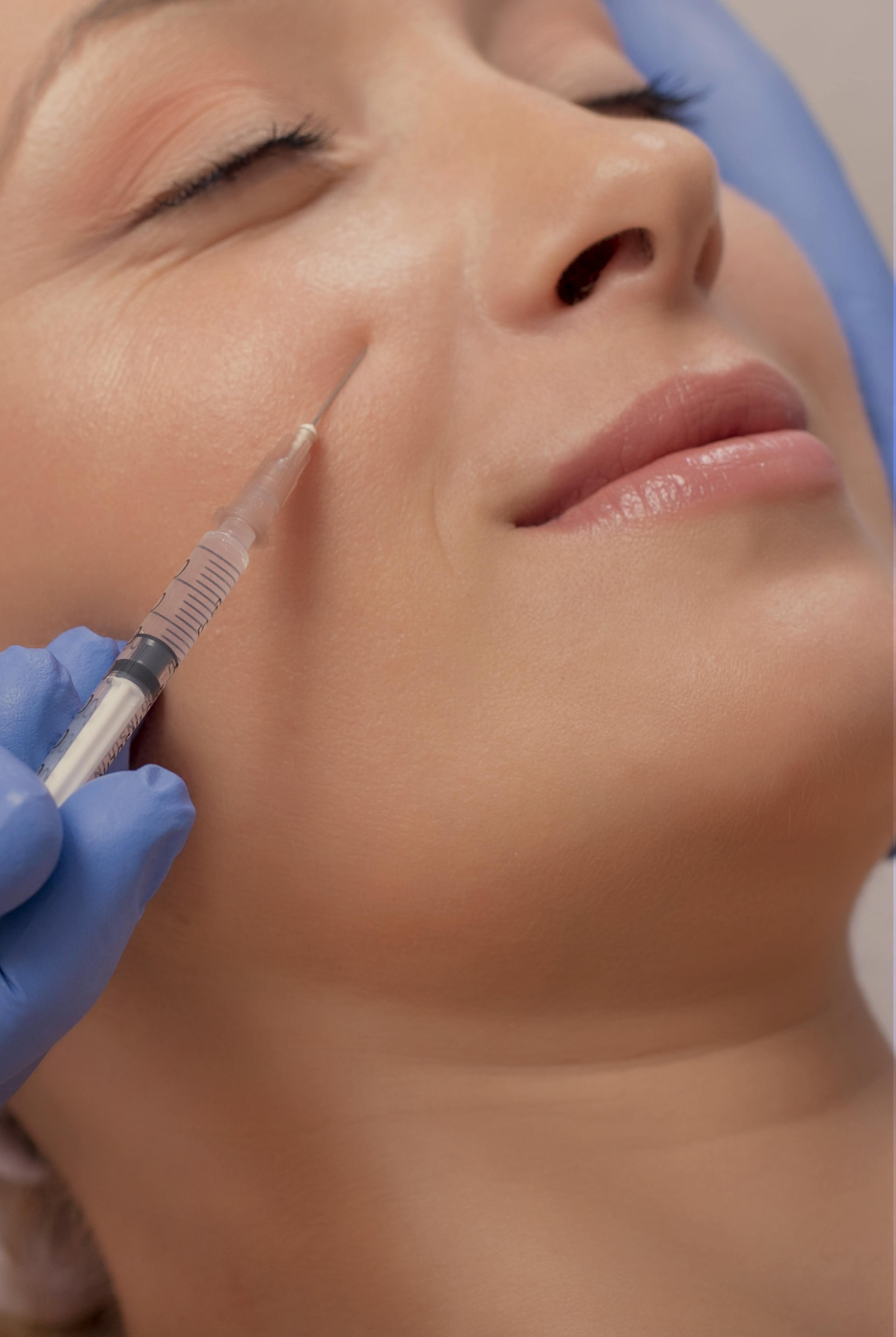 cheek filler treatment being performed