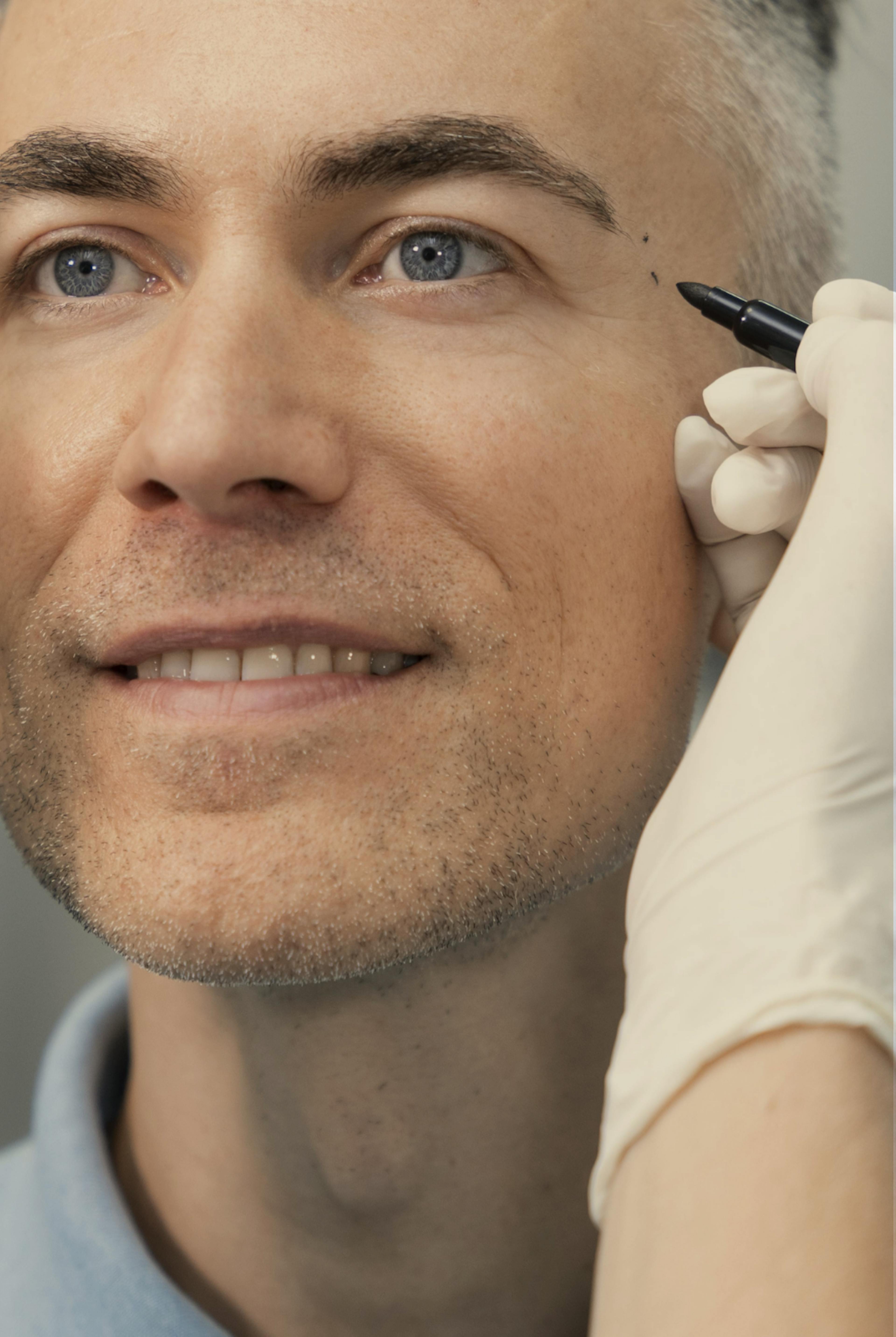 close of a man having temple filler treatment