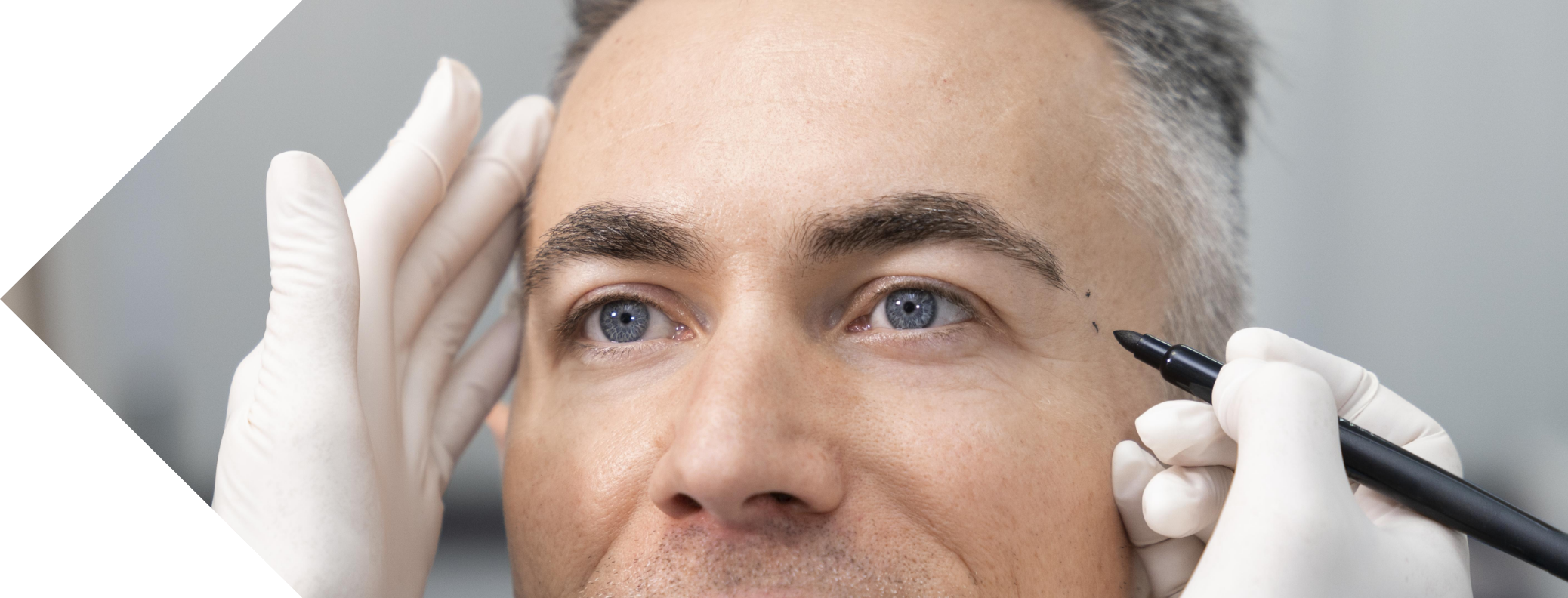 close of a man having temple filler treatment