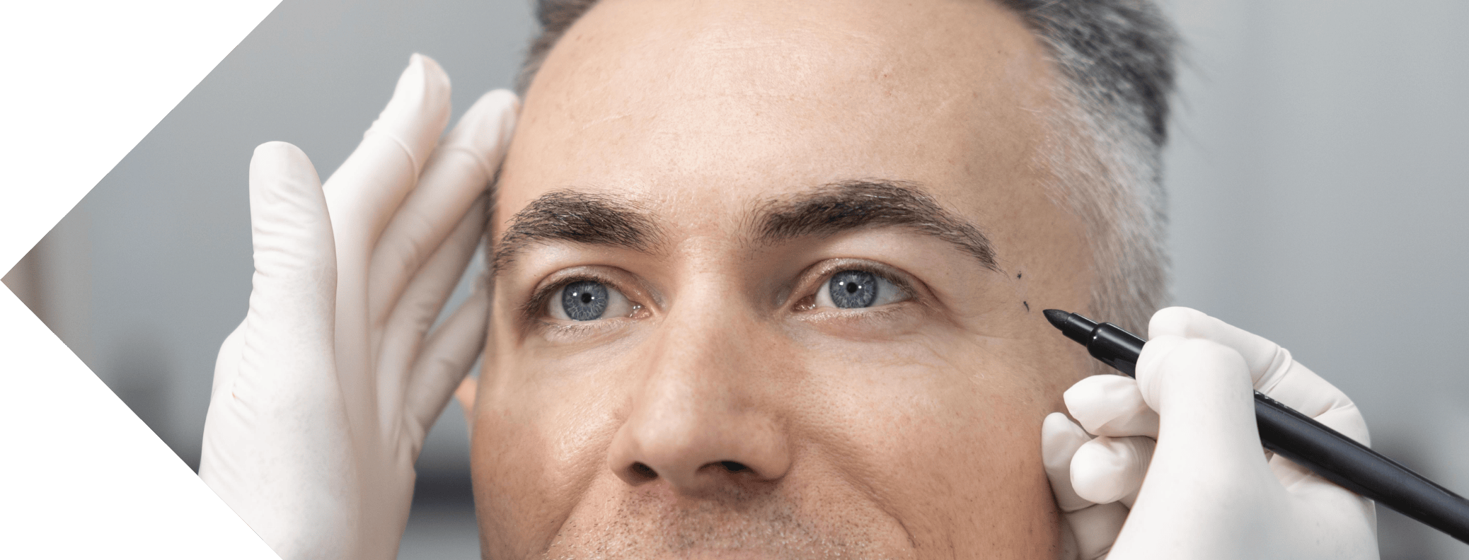 close of a man having temple filler treatment