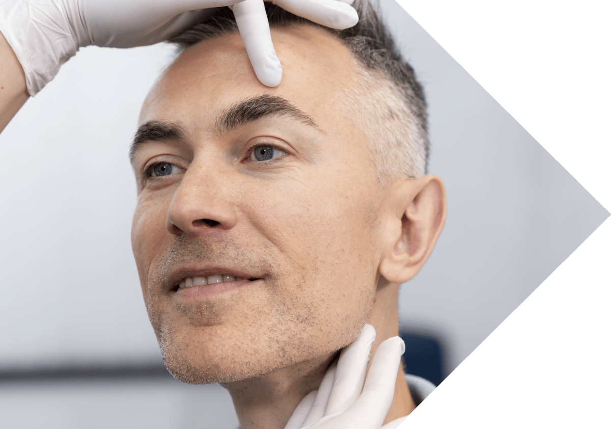 close of a man having temple filler treatment