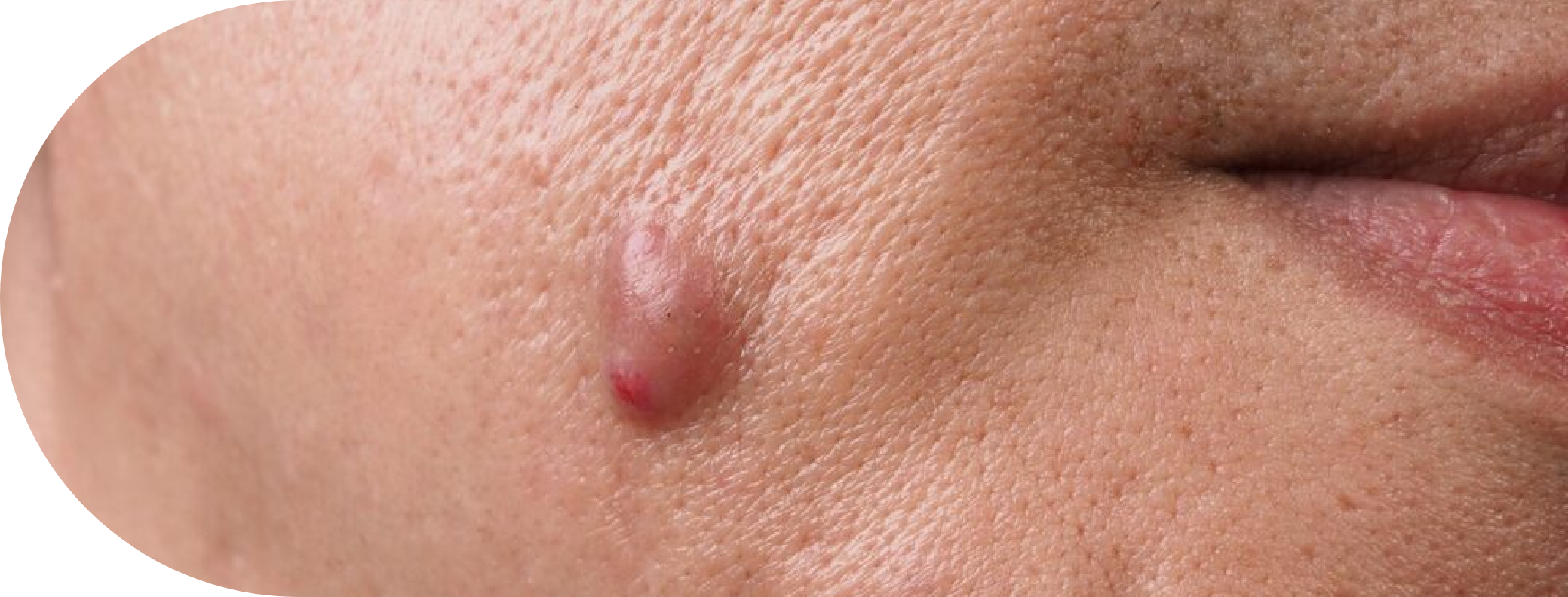 Man with a Sebaceous Cyst on his face