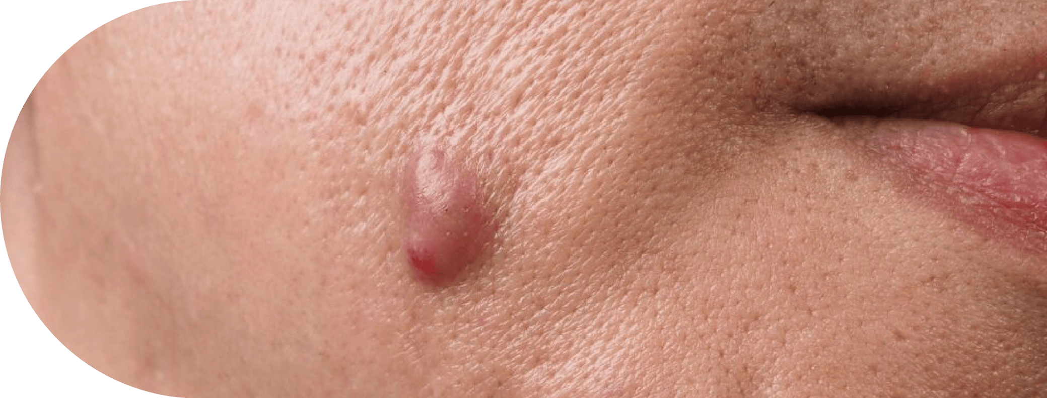 Man with a Sebaceous Cyst on his face