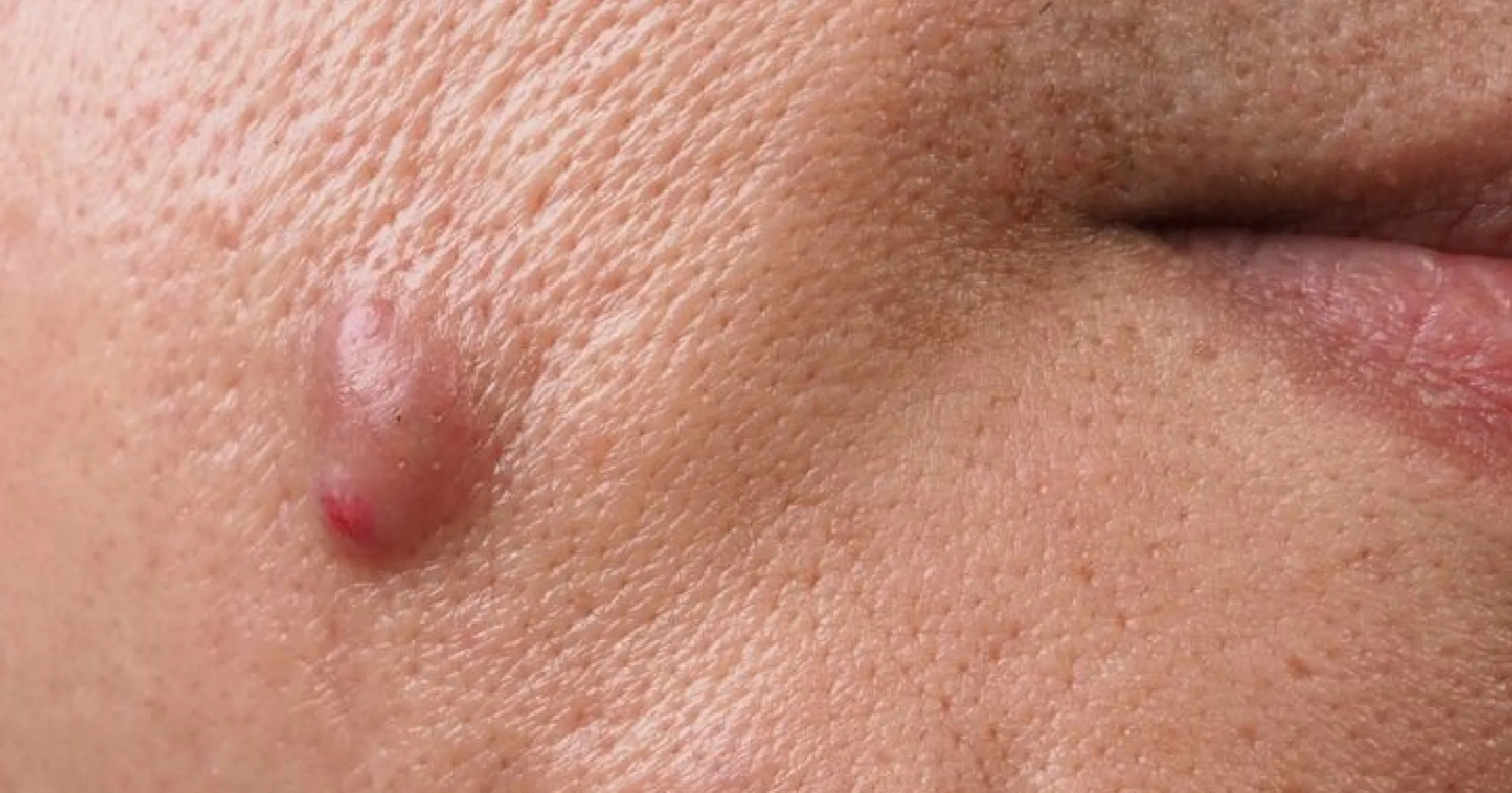 Sebaceous Cysts Sebaceous Cyst Treatment | Skyn Doctor Huddersfield