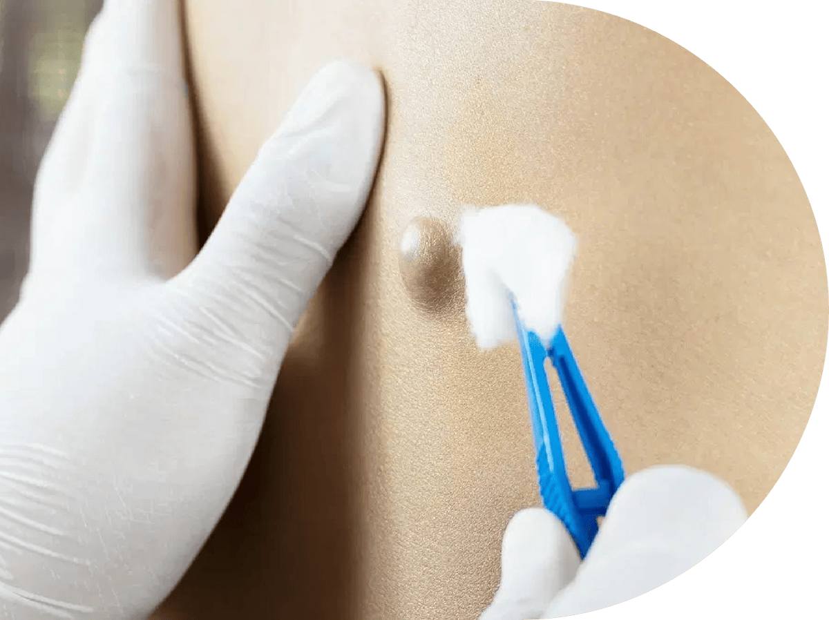 Patient with a Sebaceous Cyst being treated