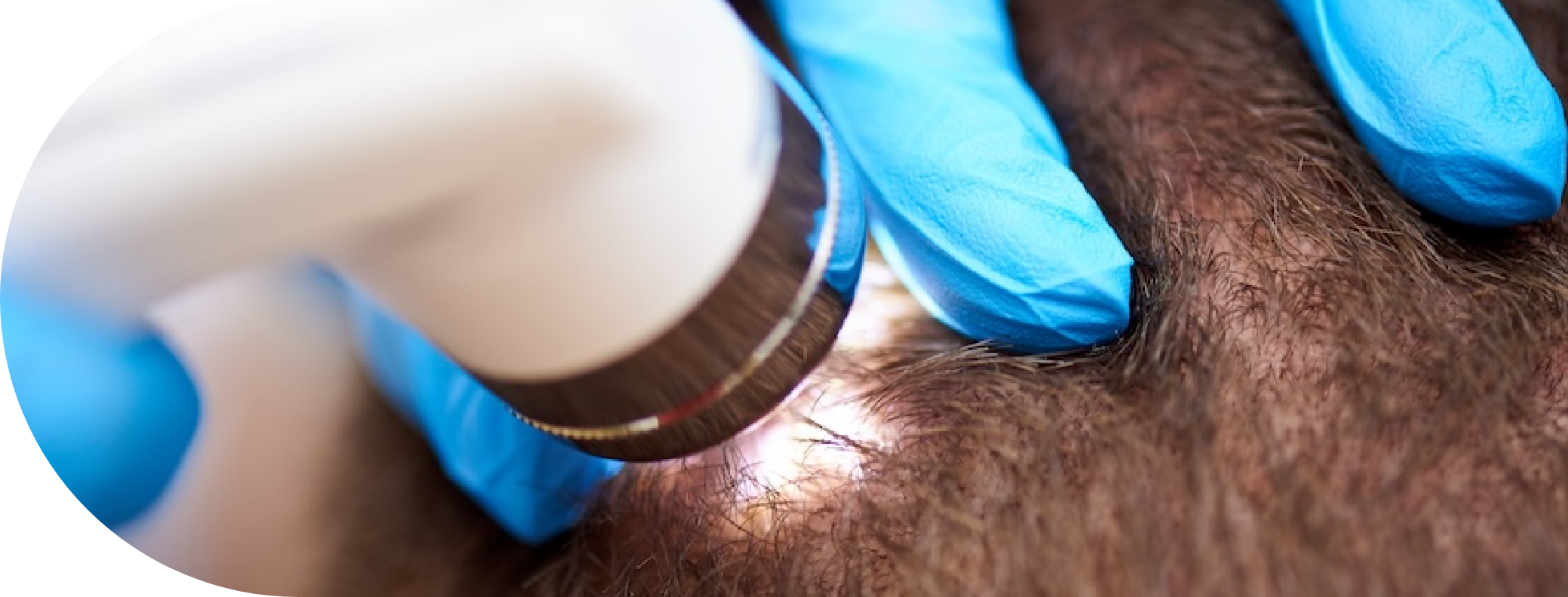 Patient having Pilar Cyst removal treatment