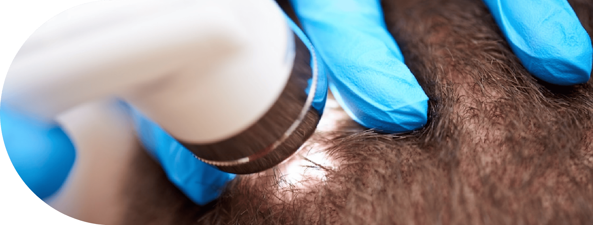 Patient having Pilar Cyst removal treatment